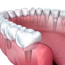 Dental Implants in Sydney