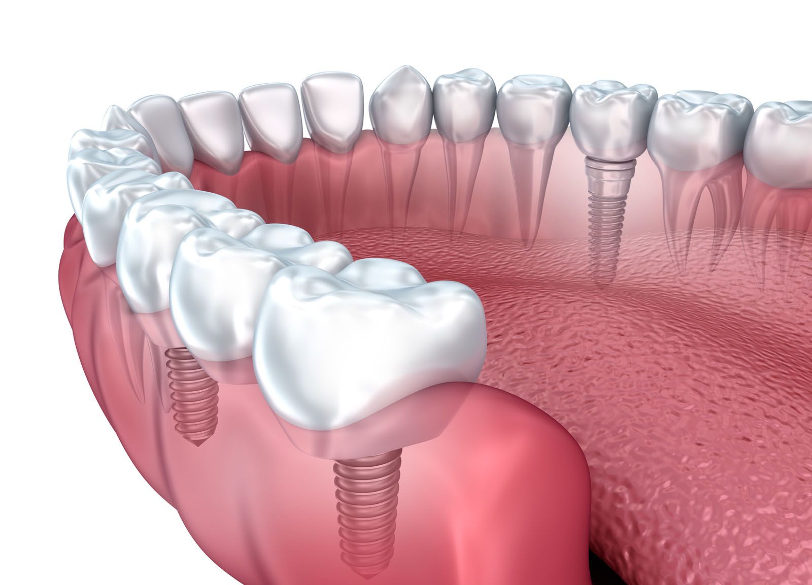 Dental Implants in Sydney