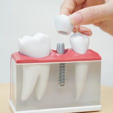 Teeth implants in Sydney