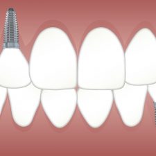 Dental Implant