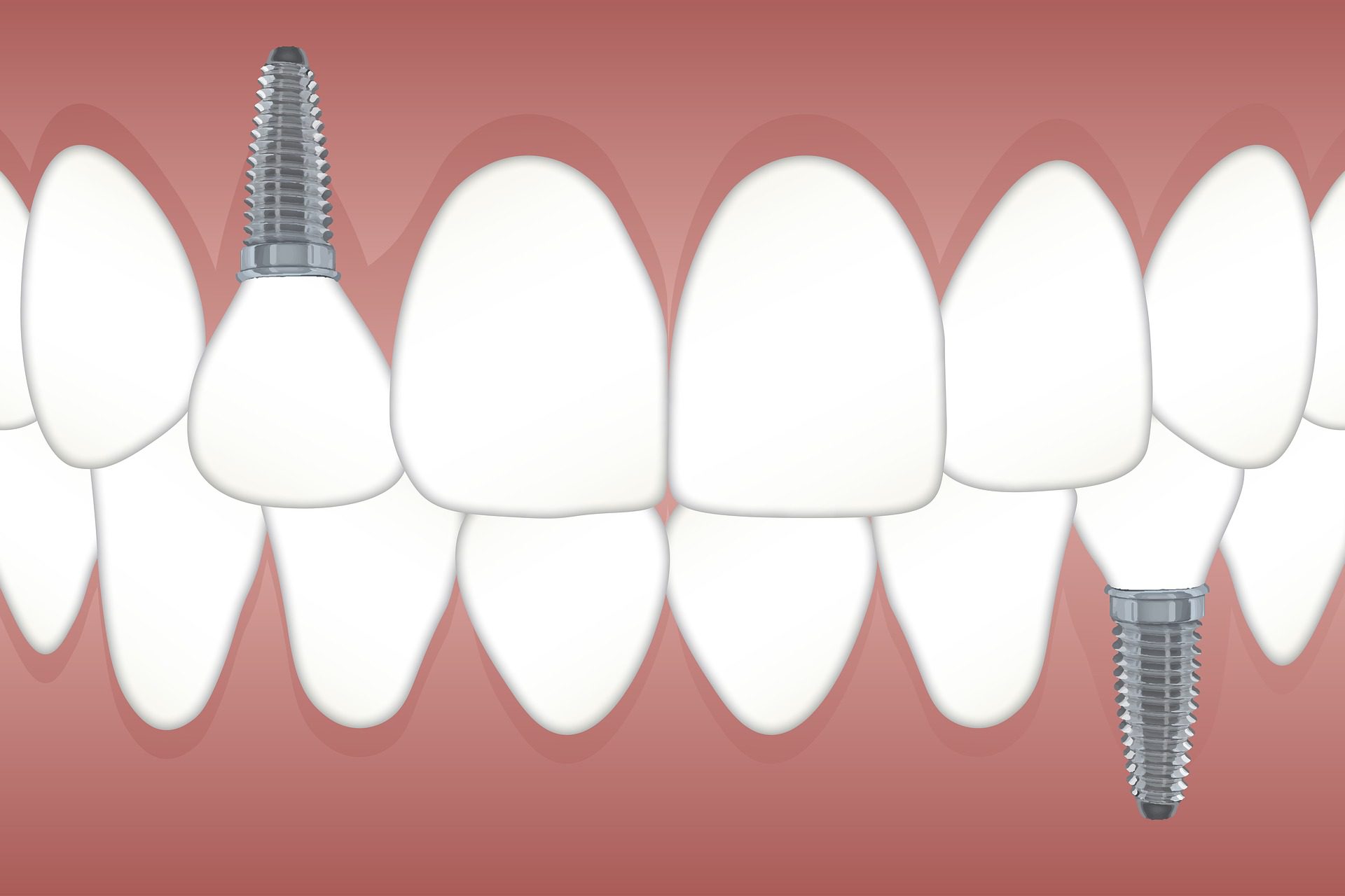 Dental Implant