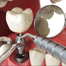 Dental Implants