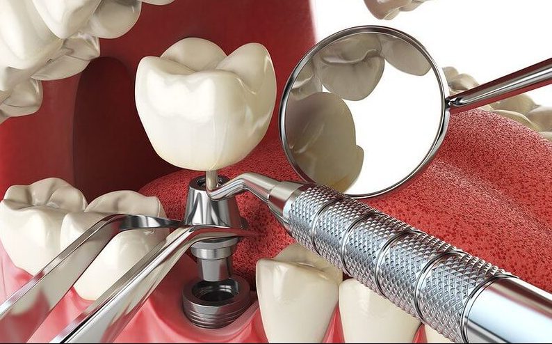 Dental Implants