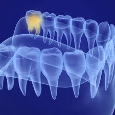 Wisdom Teeth Removal Procedure Wisdom Teeth Removal Procedure