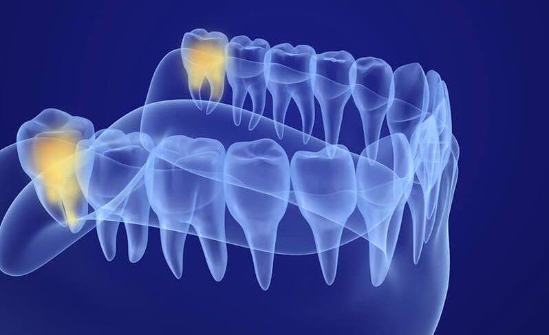 Wisdom Teeth Removal Procedure