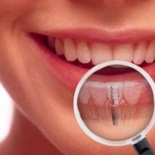 Dental Implants - Aftercare for a Smooth Experience