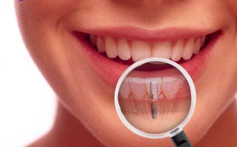 Dental Implants - Aftercare for a Smooth Experience