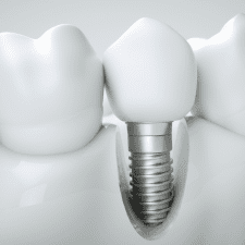 Dental implants