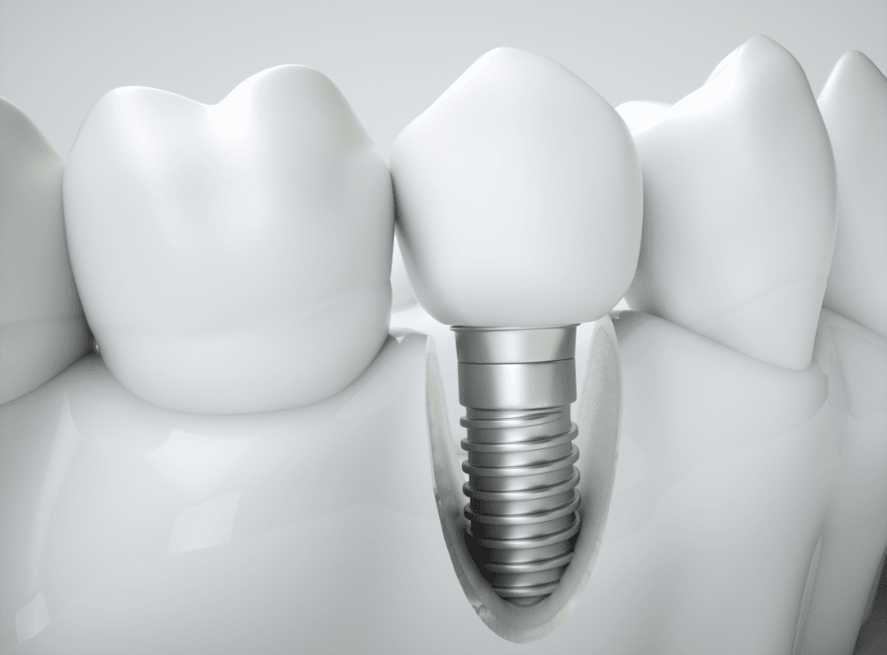 Dental implants