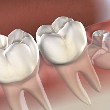 Wisdom teeth removal Procedure in Sydney