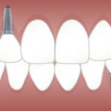 Best Option For Replacing Missing Teeth?