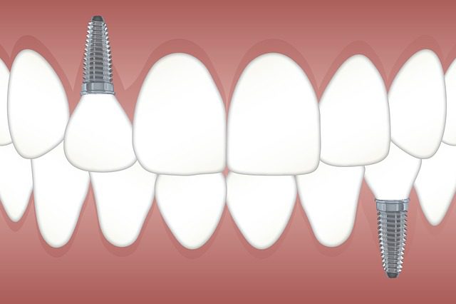 Best Option For Replacing Missing Teeth?