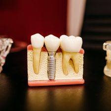 Dental Implants Treatment