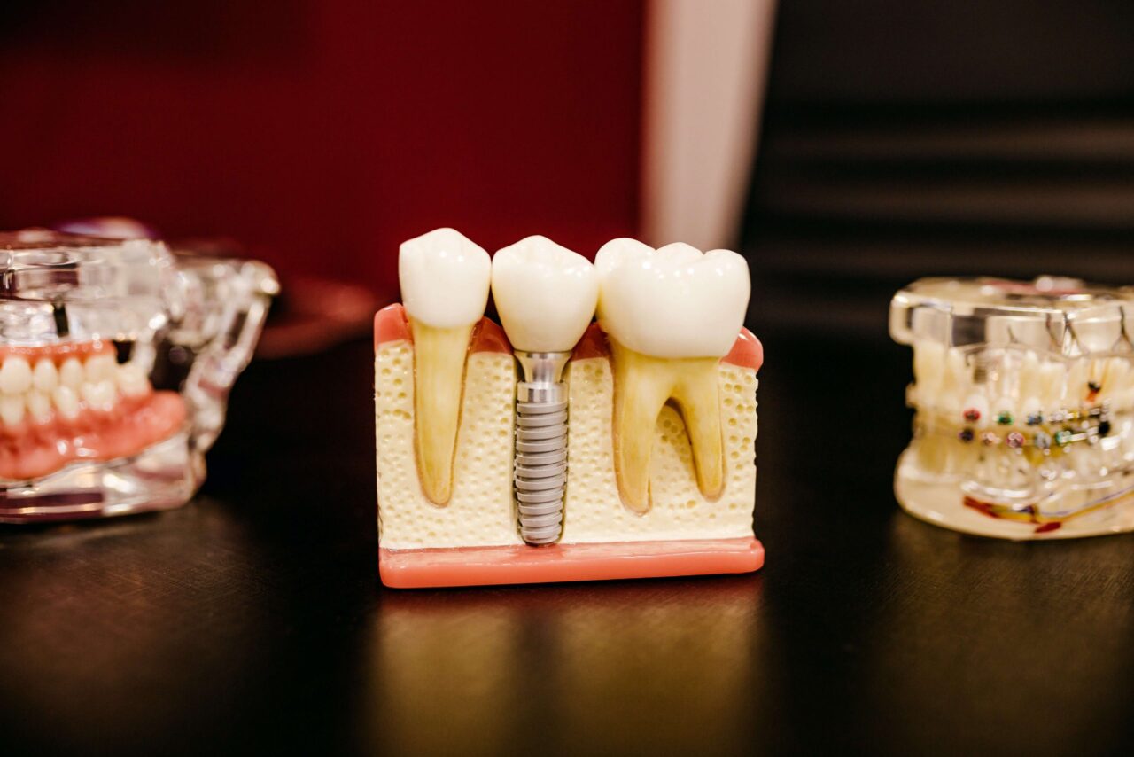 Dental Implants Treatment