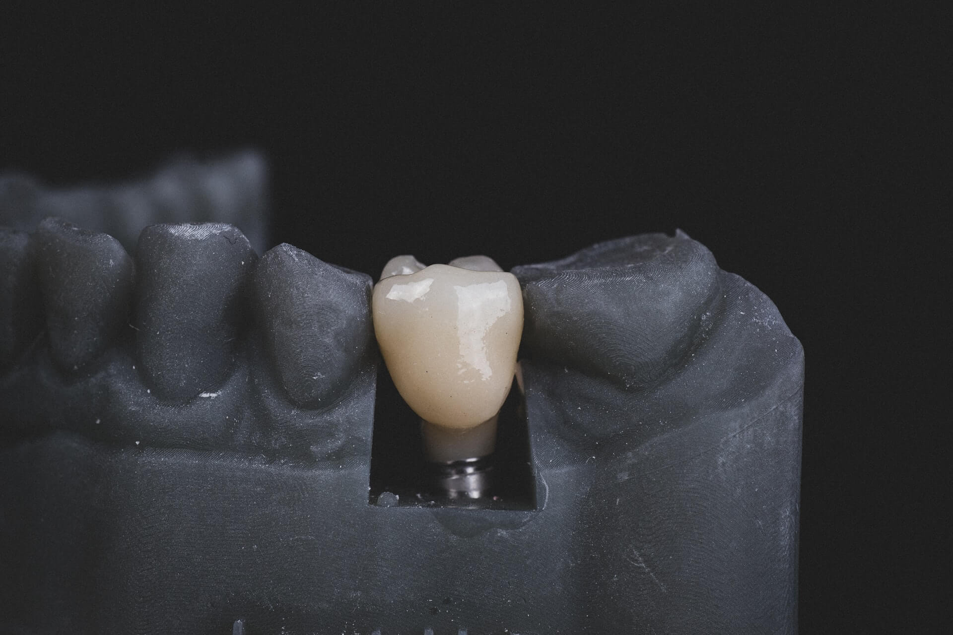 Avoid these 5 Mistakes in Your Dental Implants Treatment