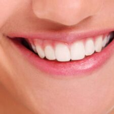 cheap dental implants in Sydney