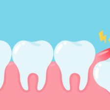 wisdom teeth removal cost Sydney