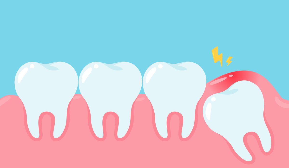 wisdom teeth removal cost Sydney