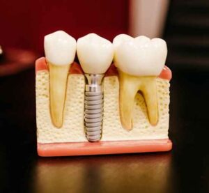 Sydney dental implants