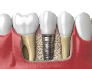 Tooth Implants Sydney