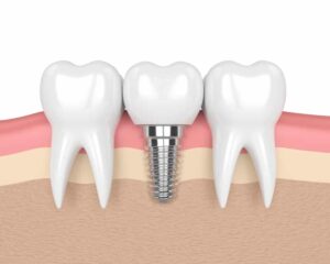 Affordable Dental Implants Sydney