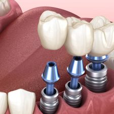 dental implants Sydney - dr paulo pinho oral surgery clinic - sydney dental implants Sydney - dr paulo pinho oral surgery clinic - sydney