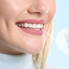 Dental implants Sydney - dr paulo pinho oral surgery clinic - sydney