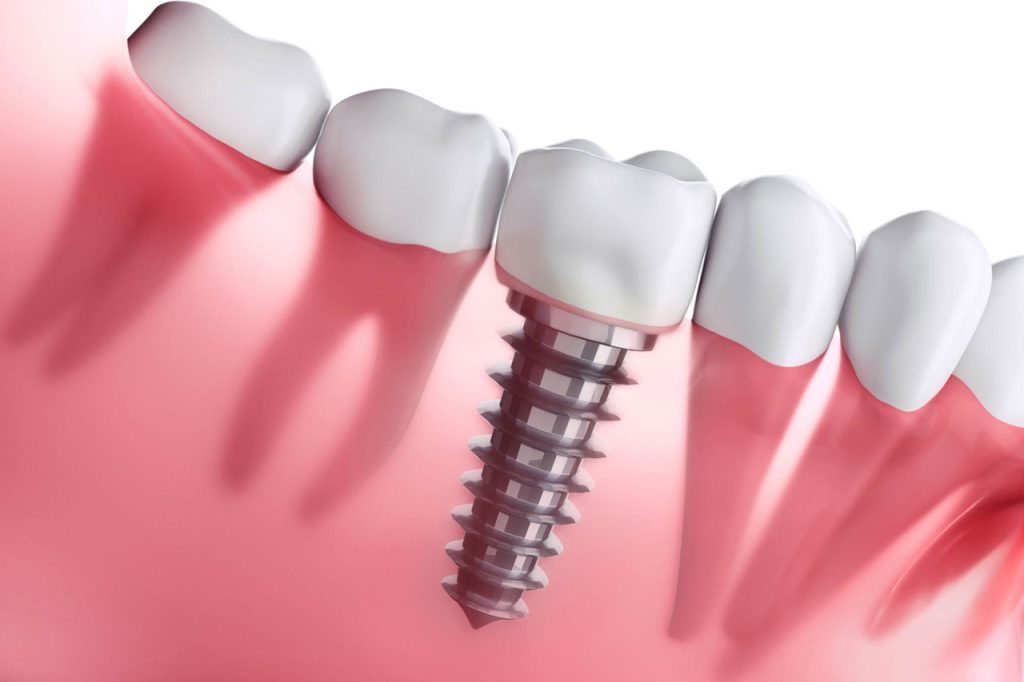 Can You Get an MRI with Dental Implants?