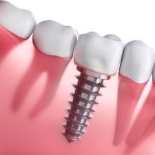 Dental Implants Safe for MRI - dr paulo pinho oral surgery clinic - sydney Dental Implants Safe for MRI - dr paulo pinho oral surgery clinic - sydney