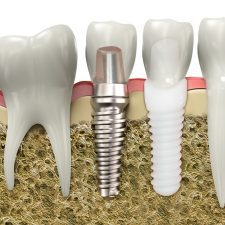 Dental Implant Lifespan Dental Implant Lifespan: Titanium vs. Zirconia