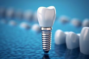 Biocompatible dental implants in Australia designed for safe integration with natural bone