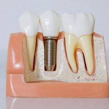 Dental Implants Guiding Your Choices for a Healthy Smile in Australia