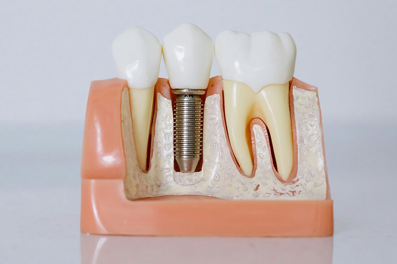 Dental Implants Guiding Your Choices for a Healthy Smile in Australia