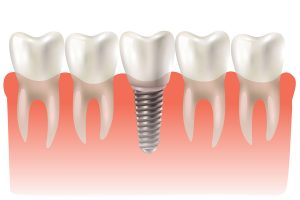 Dental Implants Sydney Clinical Outcomes - Effective Tooth Replacement Results