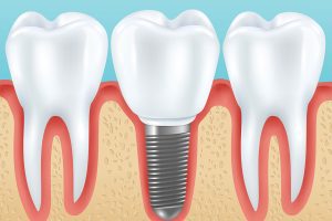 Dental Implants in Australia - Long-Lasting Tooth Replacement Solution