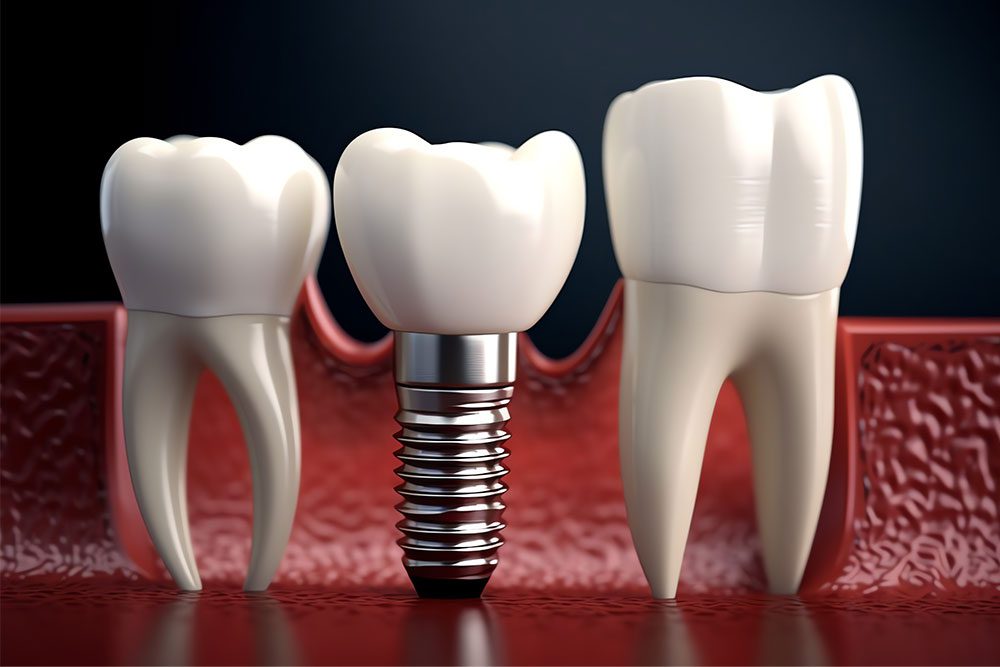 Dental implant model with artificial tooth for tooth replacement