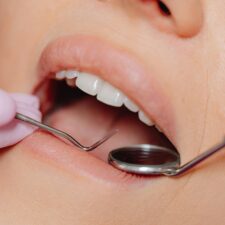 Wisdom teeth recovery day by day dental checkup during healing process