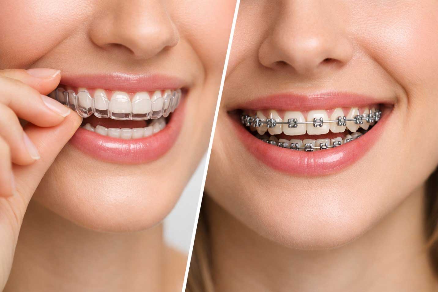 Woman wearing invisible braces for teeth straightening treatment