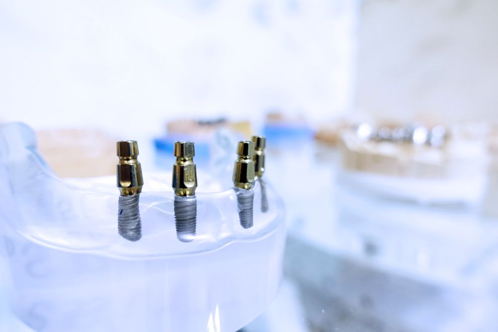 Clip-in implants showing the dental implant restoration process