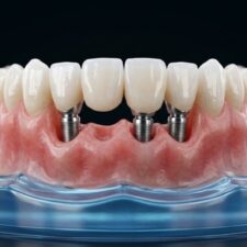 3D clip-in dental implant model with porcelain crowns