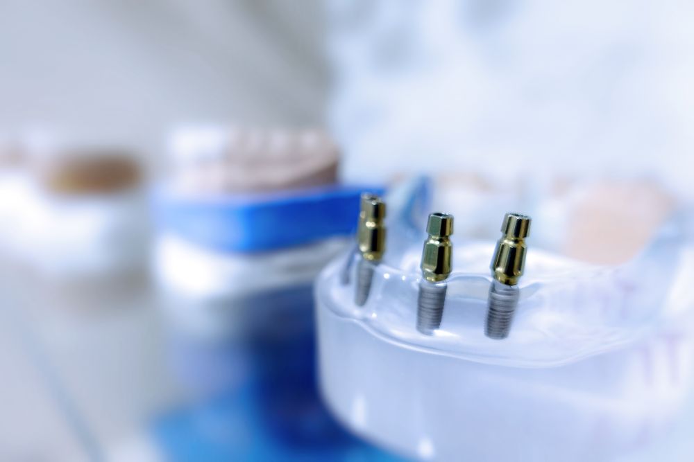Porcelain tooth plate designed for a clip-in dental implant restoration